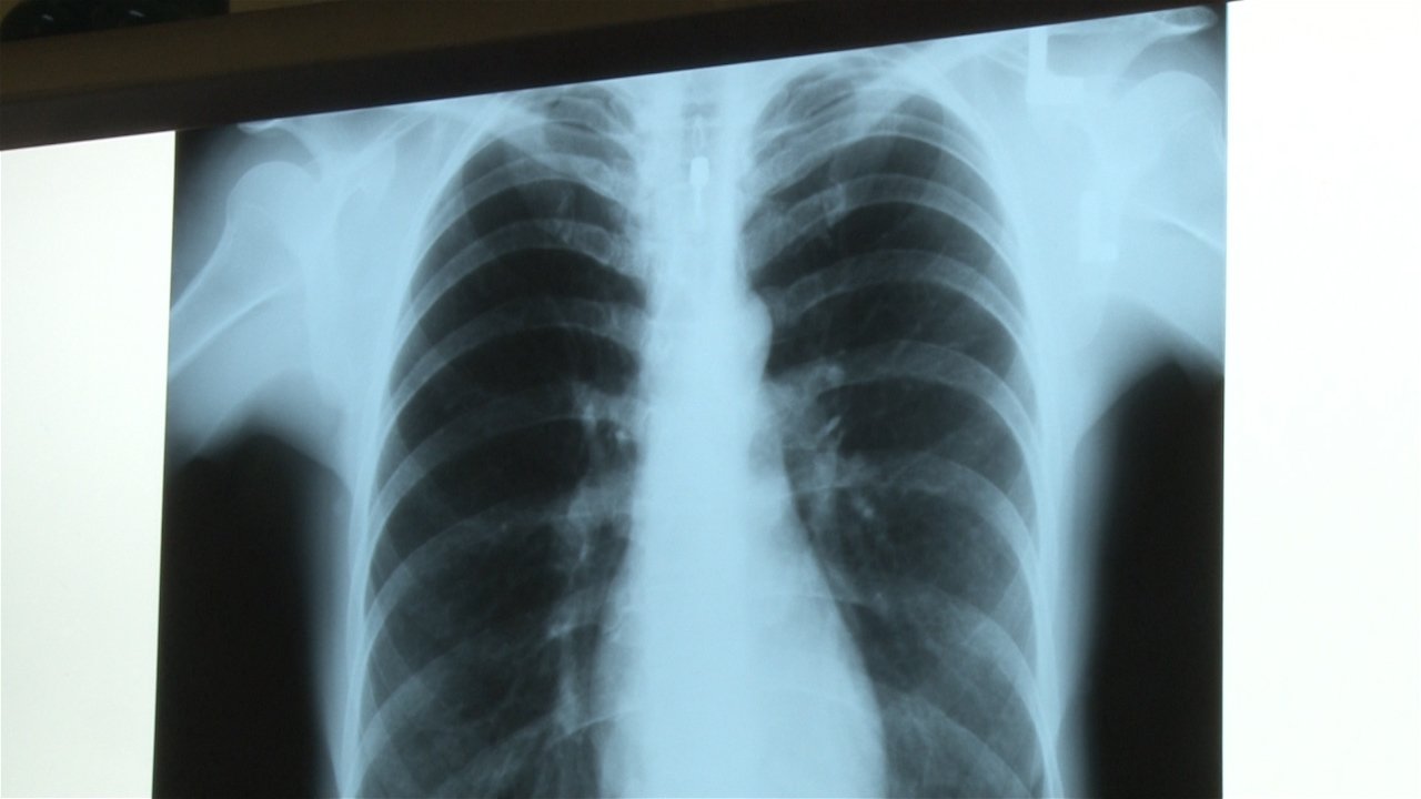 Два случаја туберкулозе од почетка године у СБО