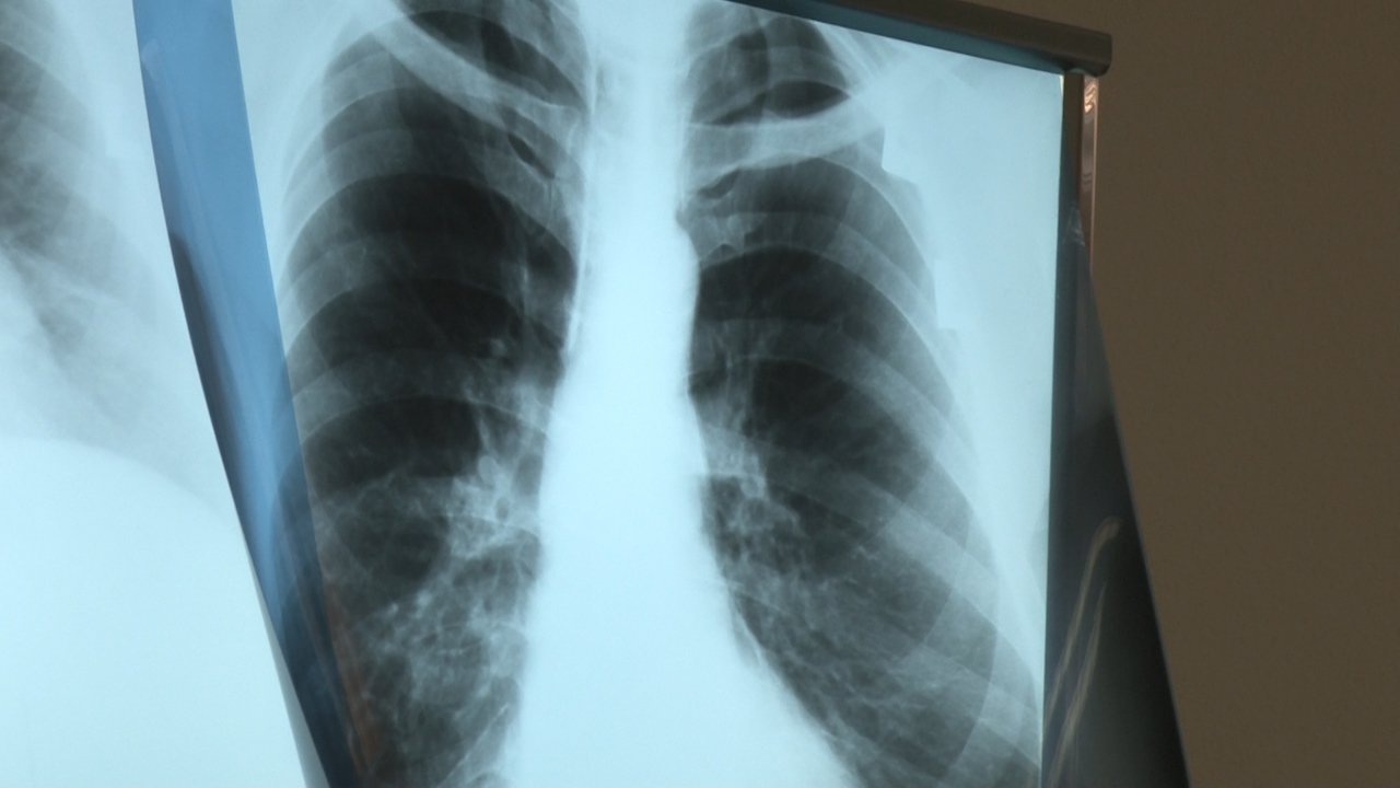 Туберкулозу је важно открити и лечити на време 