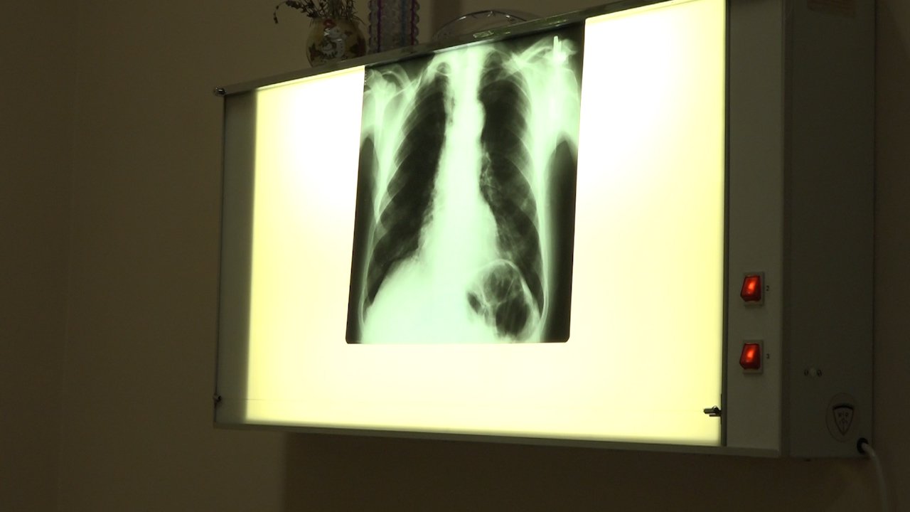 Туберколоза и даље присутна , ситуација у СБО повољна
